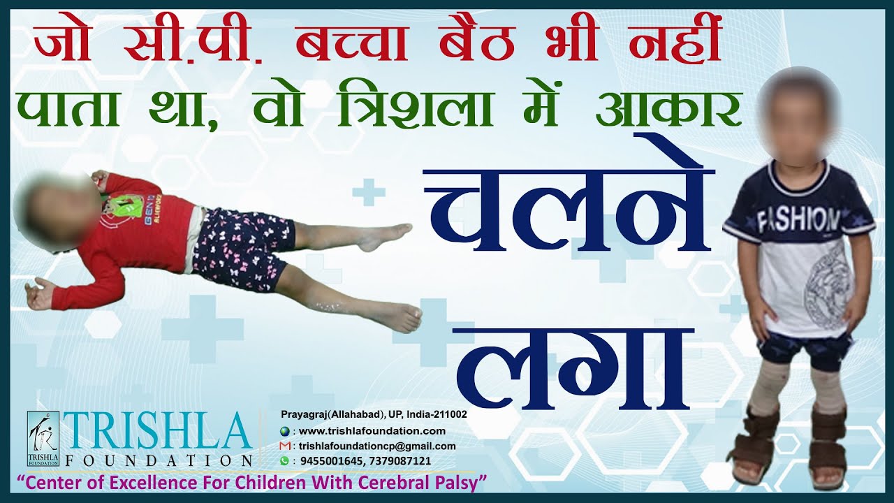 Success Story of Child with Cerebral Palsy: Started Walking Independently After Treatment