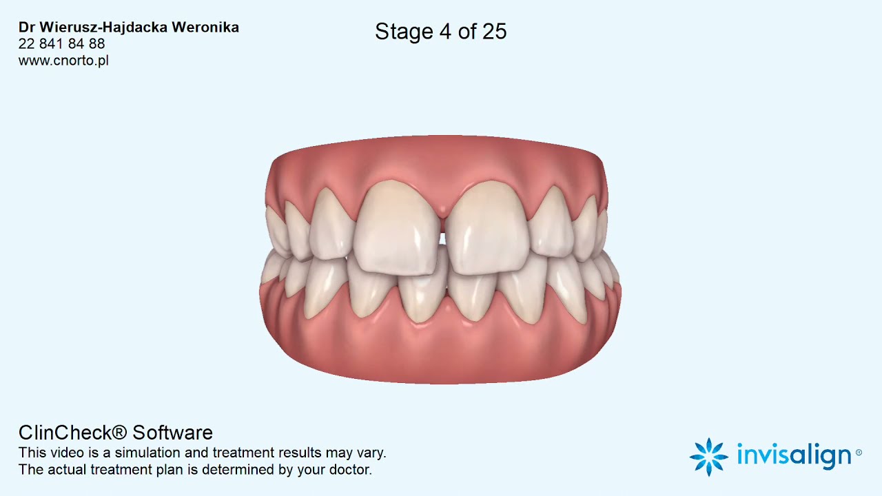 Leczenie wad zgryzu aparatem ortodontycznym - diastema, zgryz krzyżowy boczny.