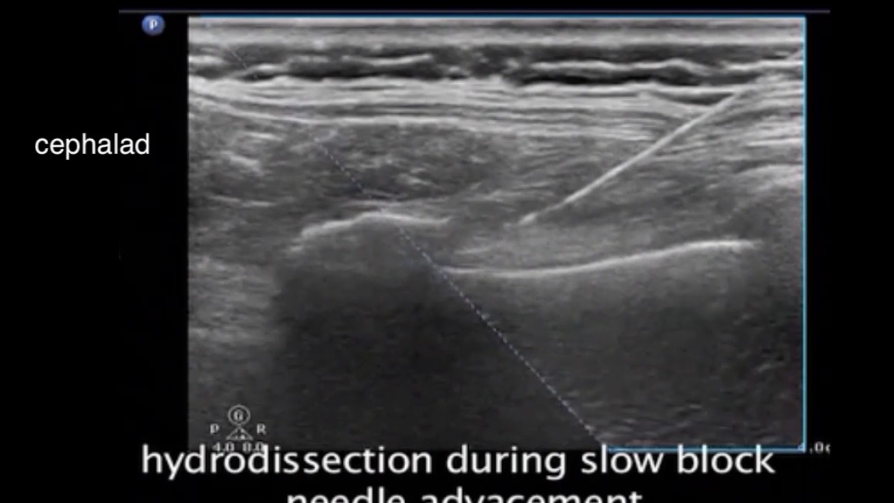 Intercostal Nerve Block