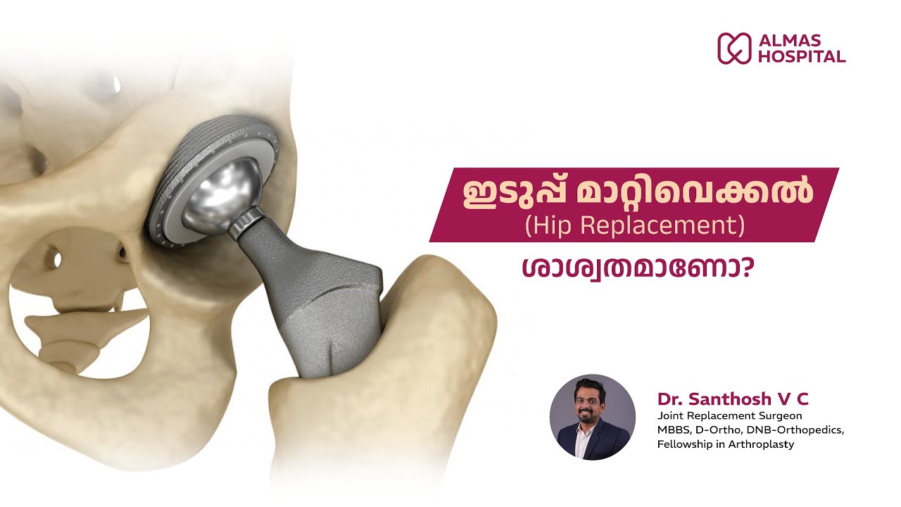 ഇടുപ്പ് മാറ്റിവെക്കൽ (Hip replacement) അറിയേണ്ടതെല്ലാം
