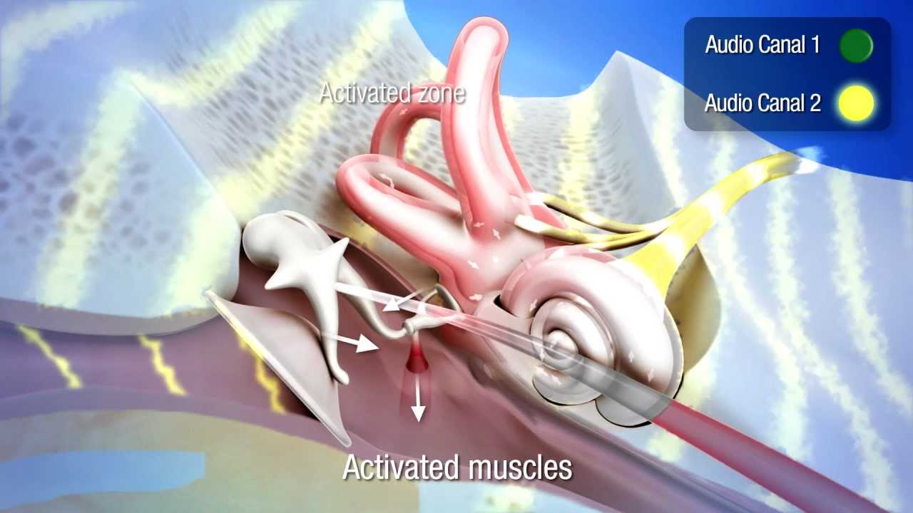 Listening therapy with the Tomatis® Effect - 3D