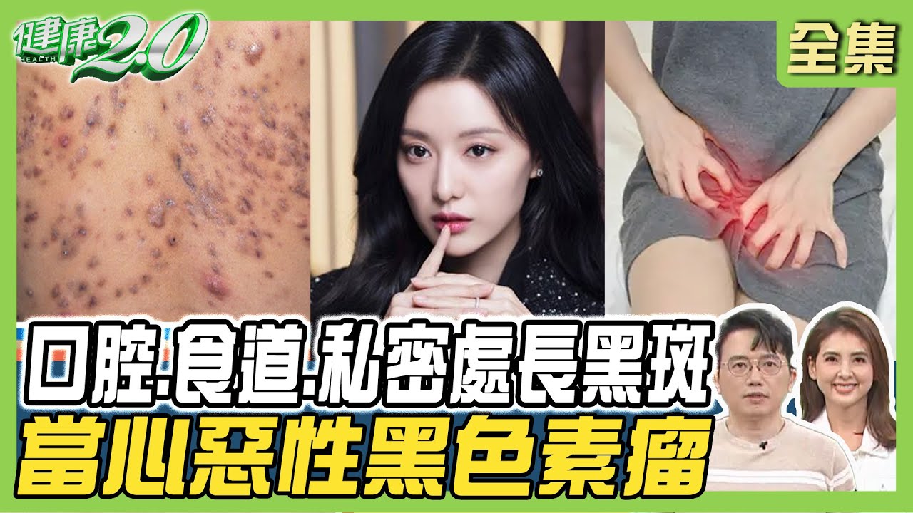 私密處長黑斑竟是惡性黑色素瘤！金智媛喝高麗菜水抗痘！濕疹好不了恐是癌！？健康2.0 20240519【完整版】江坤俊 韋汝 陳欣湄 吳吉妮 羅珮琳 趙函穎 雷議宗@tvbshealth20