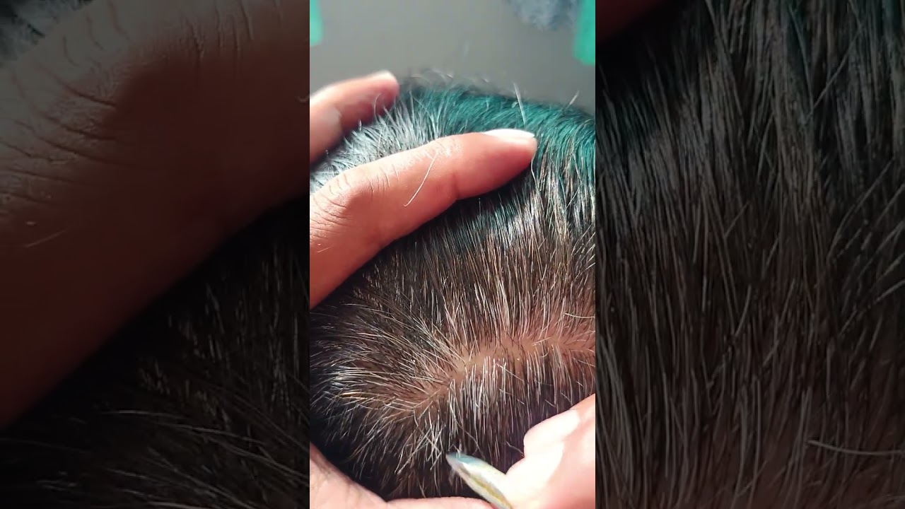 Most satisfying white hair removal 1.30 part 1#relaxing #satisfying #stressremoval 