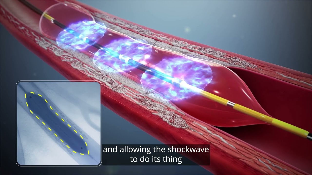 Cardiac Shockwave