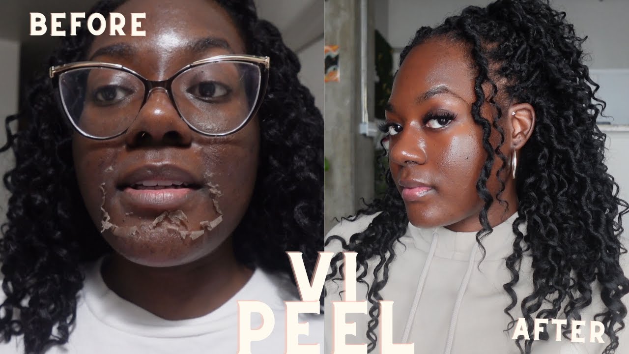 I got a  VI chemical peel ! 7 day chemical peel process|VI Peel on Dark skin 🩷