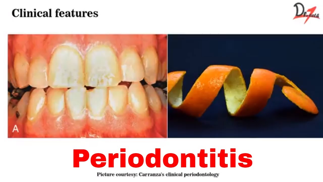 Chronic periodontitis