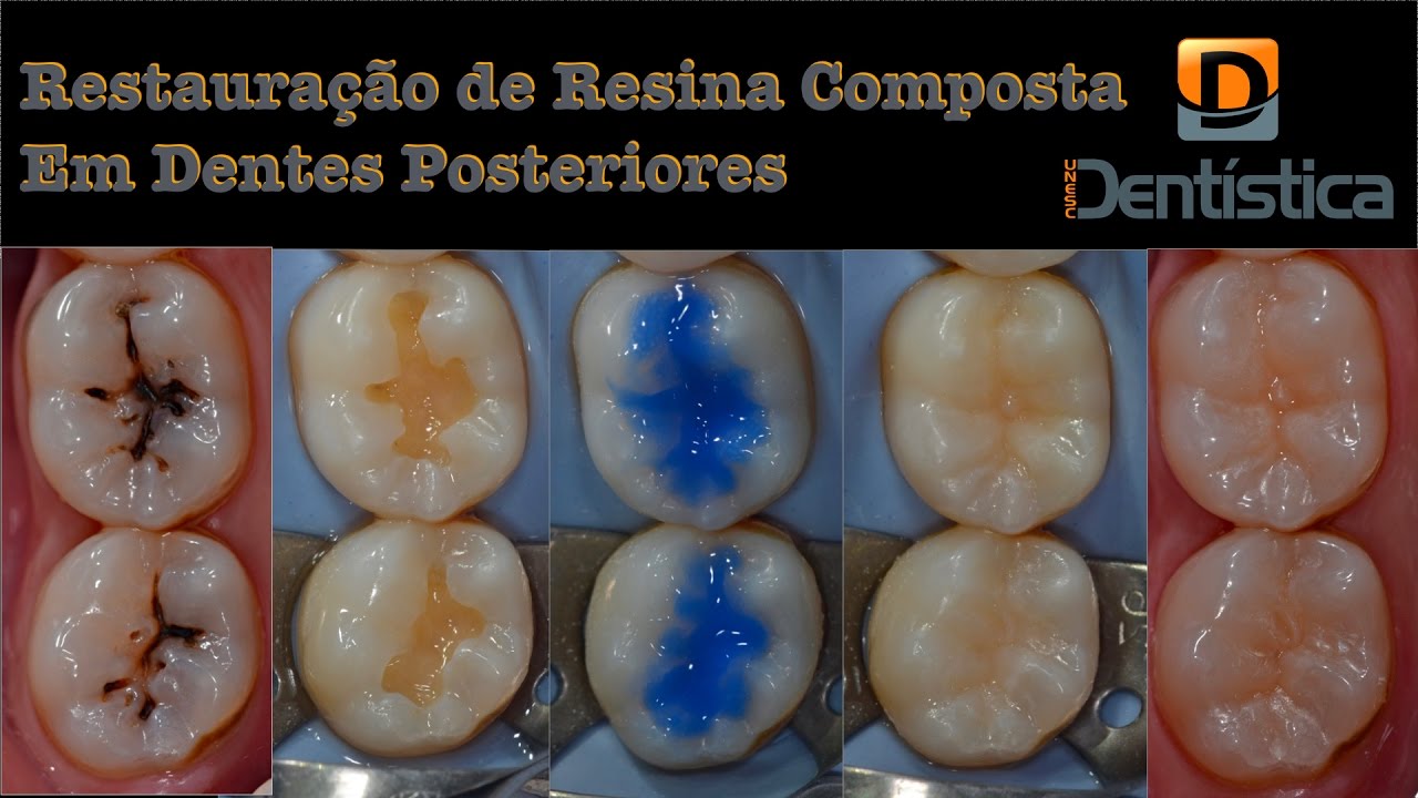 Restauração de resina composta em dente posterior