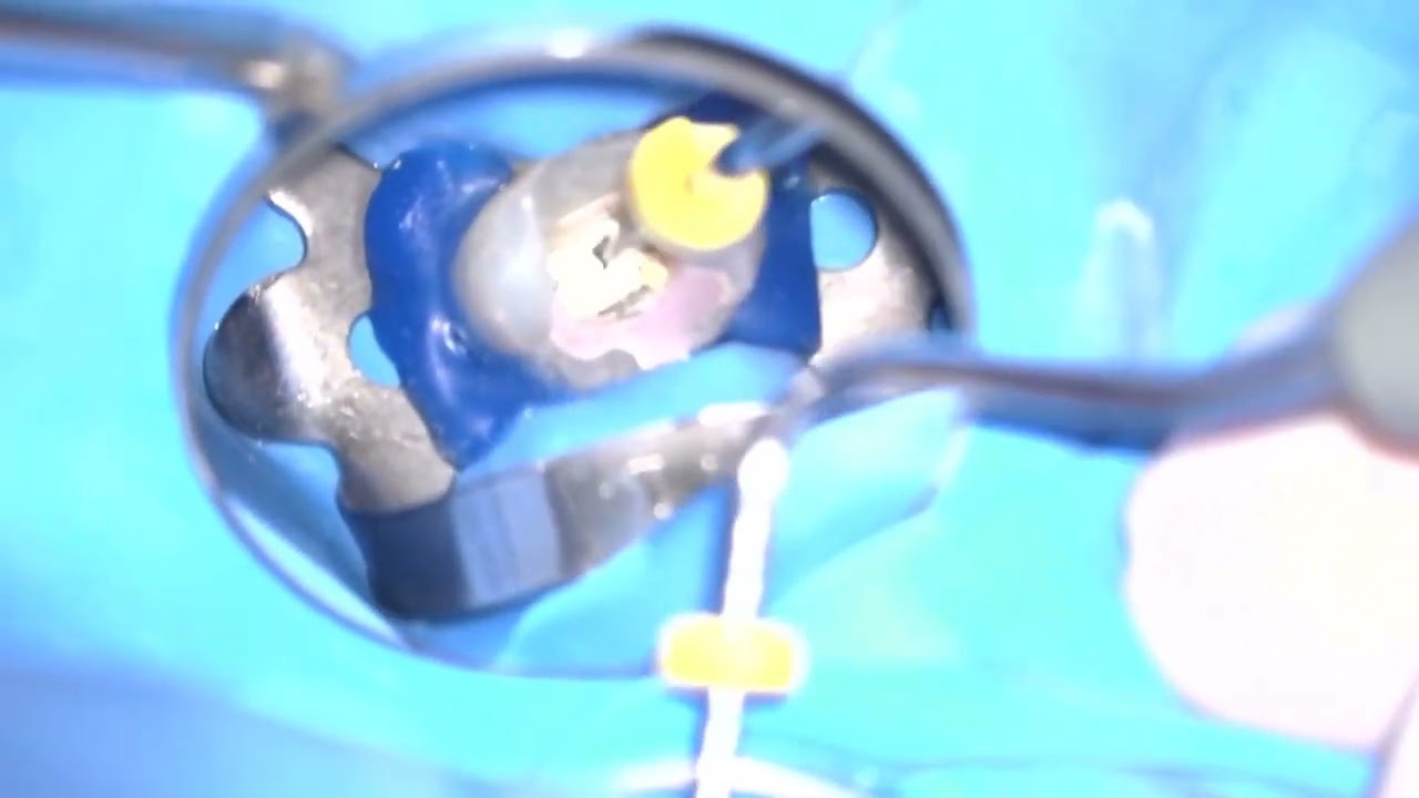 Apical Plug-Technique