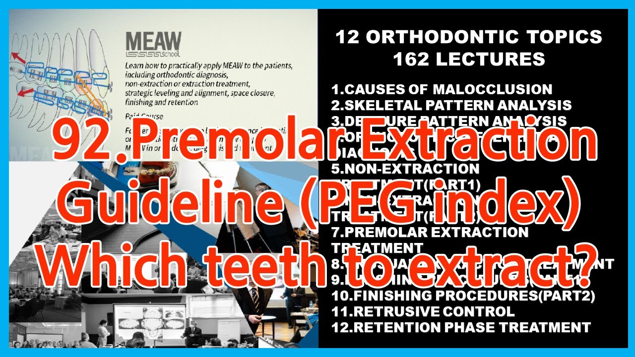 92.Premolar Extraction Guideline (PEG index) - Which teeth to extract?