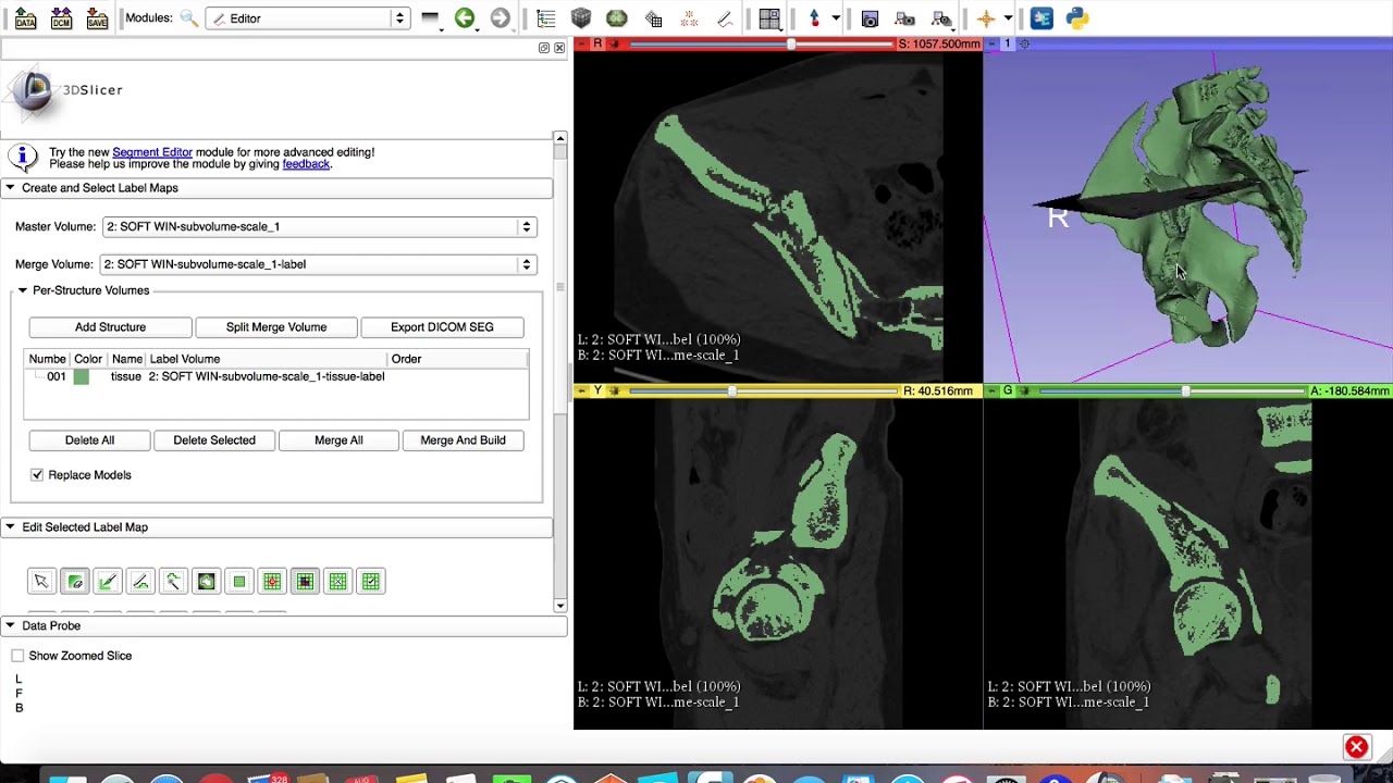 Using 3D slicer to create STL file of a fractured pelvis: Learn 3D Slicer in easy steps