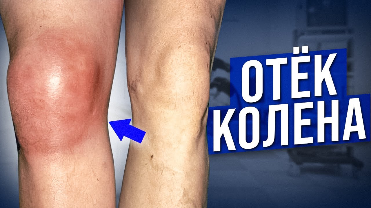 Как убрать ОТЕК колена без таблеток и мазей? Упражнения от отека коленного сустава!