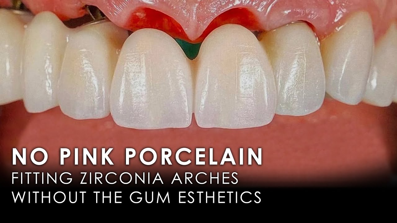 No Pink Porcelain: Fitting Zirconia Arches without the Gum Esthetics