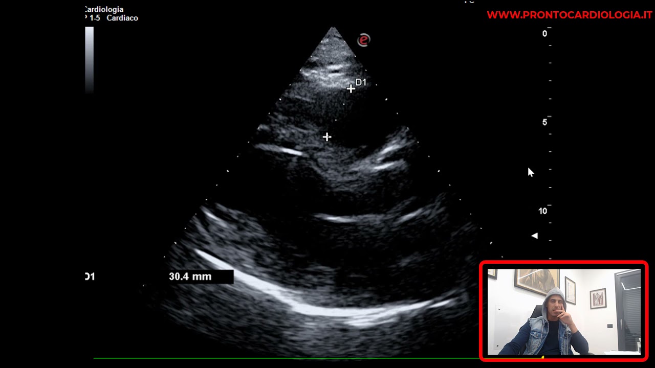 LEAK PERIPROTESICO SU PROTESI VALVOLARE AORTICA