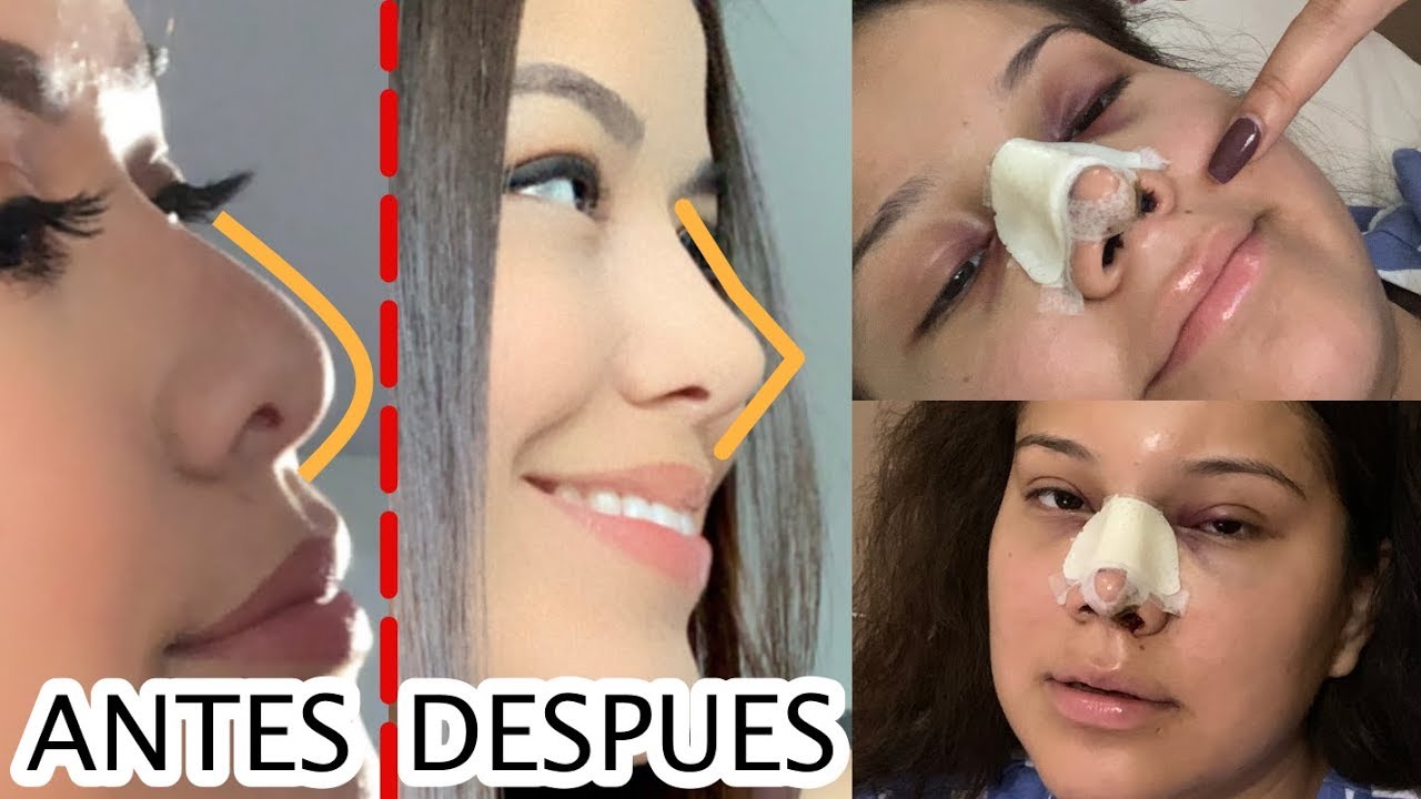 ME OPERE LA NARIZ EN ECUADOR / (Mi Experiencia)