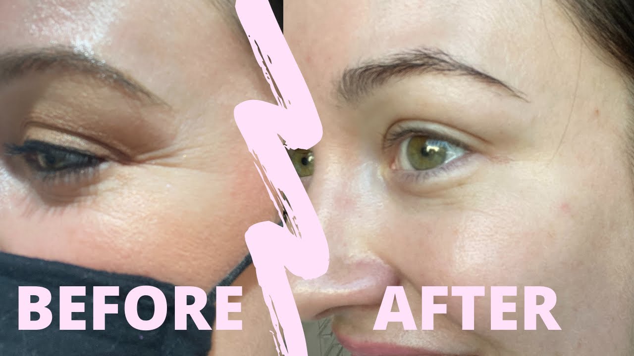 I got BABY BOTOX! My 1st time! 💉✨38 years old