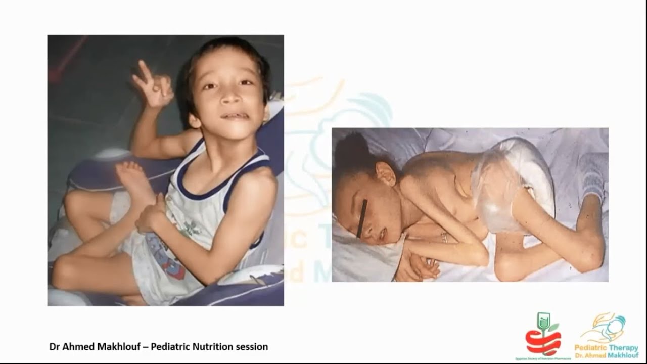 Clinical Nutrition Fundamentals for cerebral palsy pediatric patient