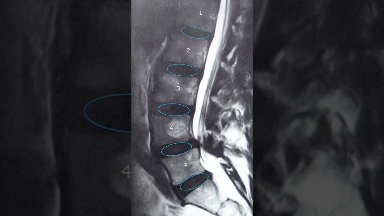 Jak czytać rezonans magnetyczny jak chirurg #fyp #doktor #mri #chirurg #b&oacute;lplec&oacute;w #learnontiktok