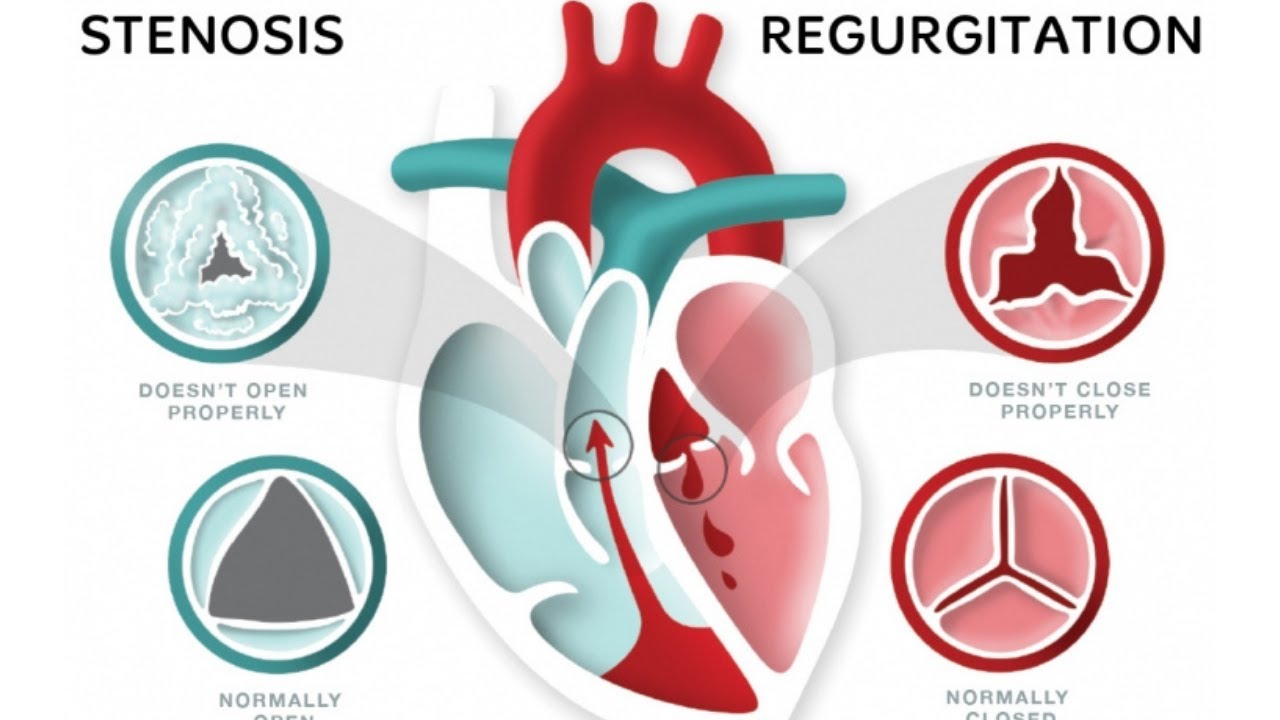 Mitral Stenosis and Regurgitation - Cardiology