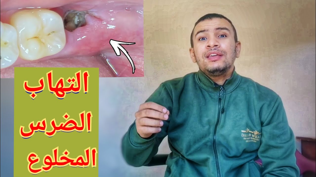 اسرع علاج منزلي لالتهاب و الم الجرح بعد خلع الضرس - اعراض تلوث مكان الضرس المخلوع
