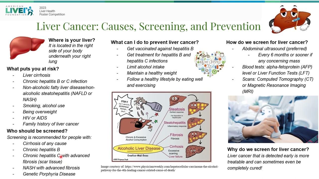 Liver Cancer: Causes, Screening, and Prevention, Dr. Liu, Dr. Lin, Dr. He, Dr. Mathialagan
