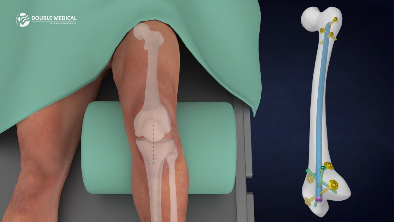 Mastering the RFN Retrograde Femoral Nailing System | Surgical Technique Animation