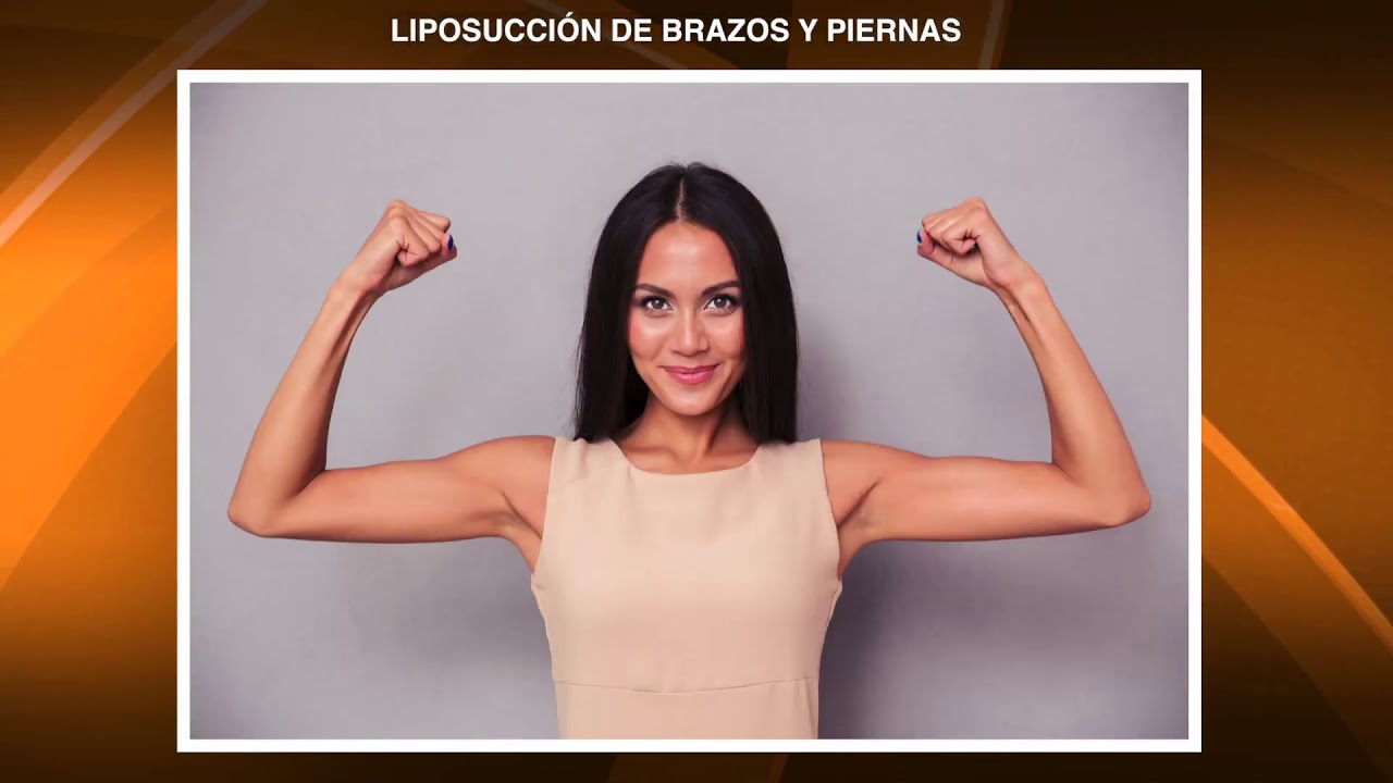 Liposucción de brazos y piernas flácidas [en 2021] | Testimonio | Cruroplastia y Braquioplastia