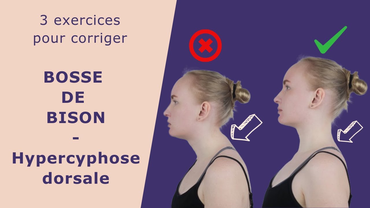 Hypercyphose dorsale : 3 exercices pour corriger