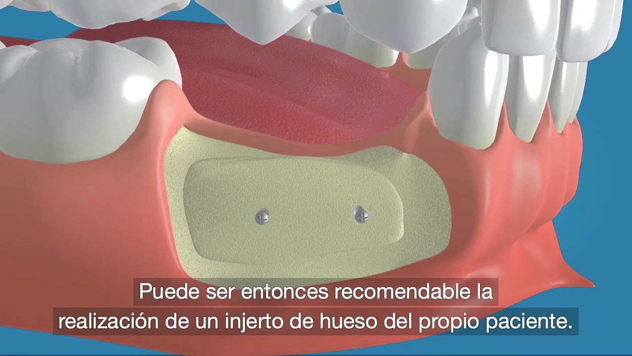 Injerto de hueso para implantes dentales | Cl&iacute;nica Dental MiBO Almer&iacute;a