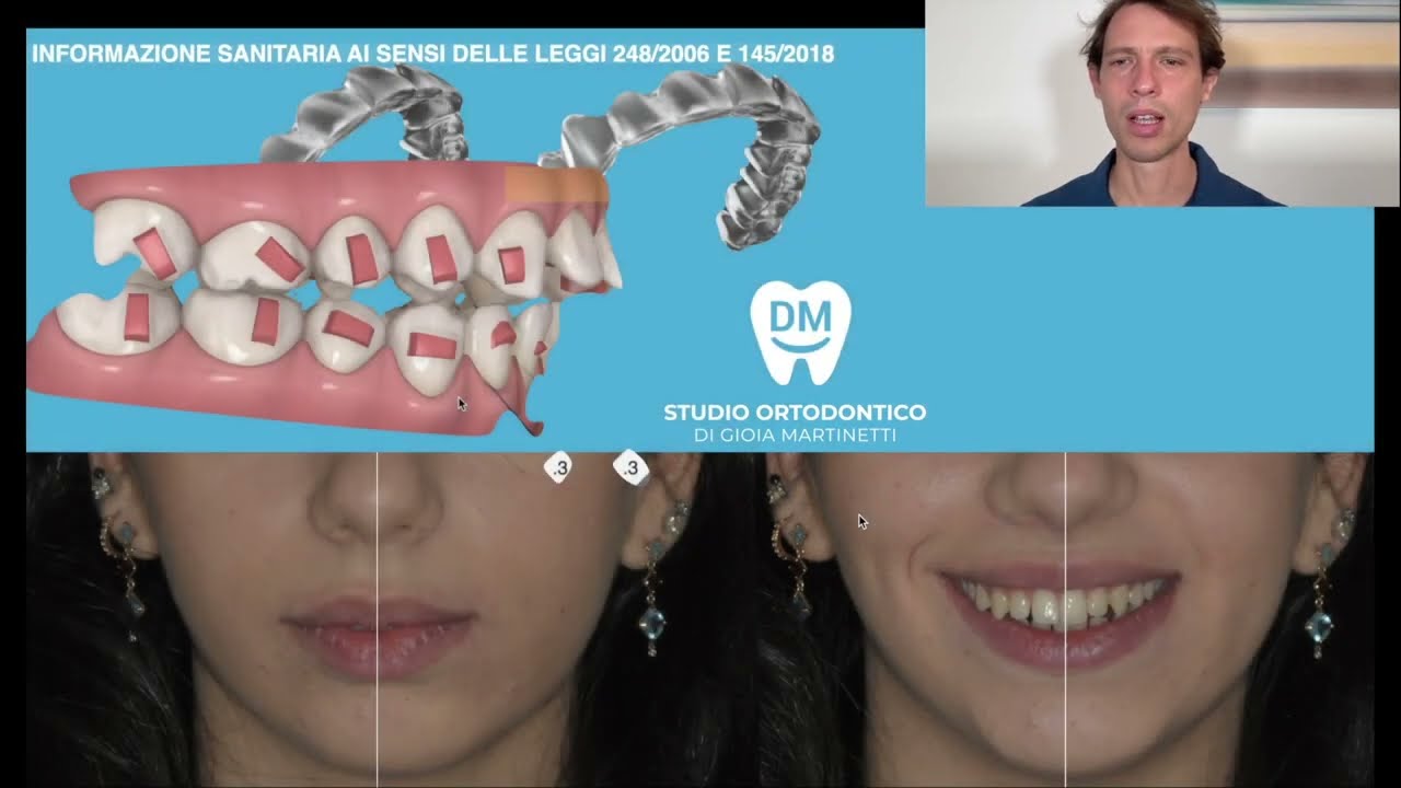 Denti in fuori e sporgenti in adulto, ortodonzia apparecchio allineatori e mascherine trasparenti