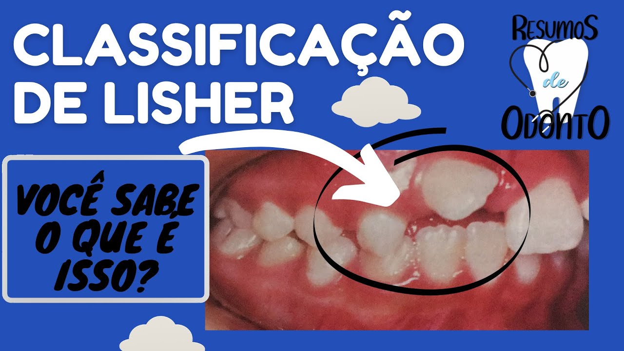 Classificação de Lisher | Resumos de Odonto