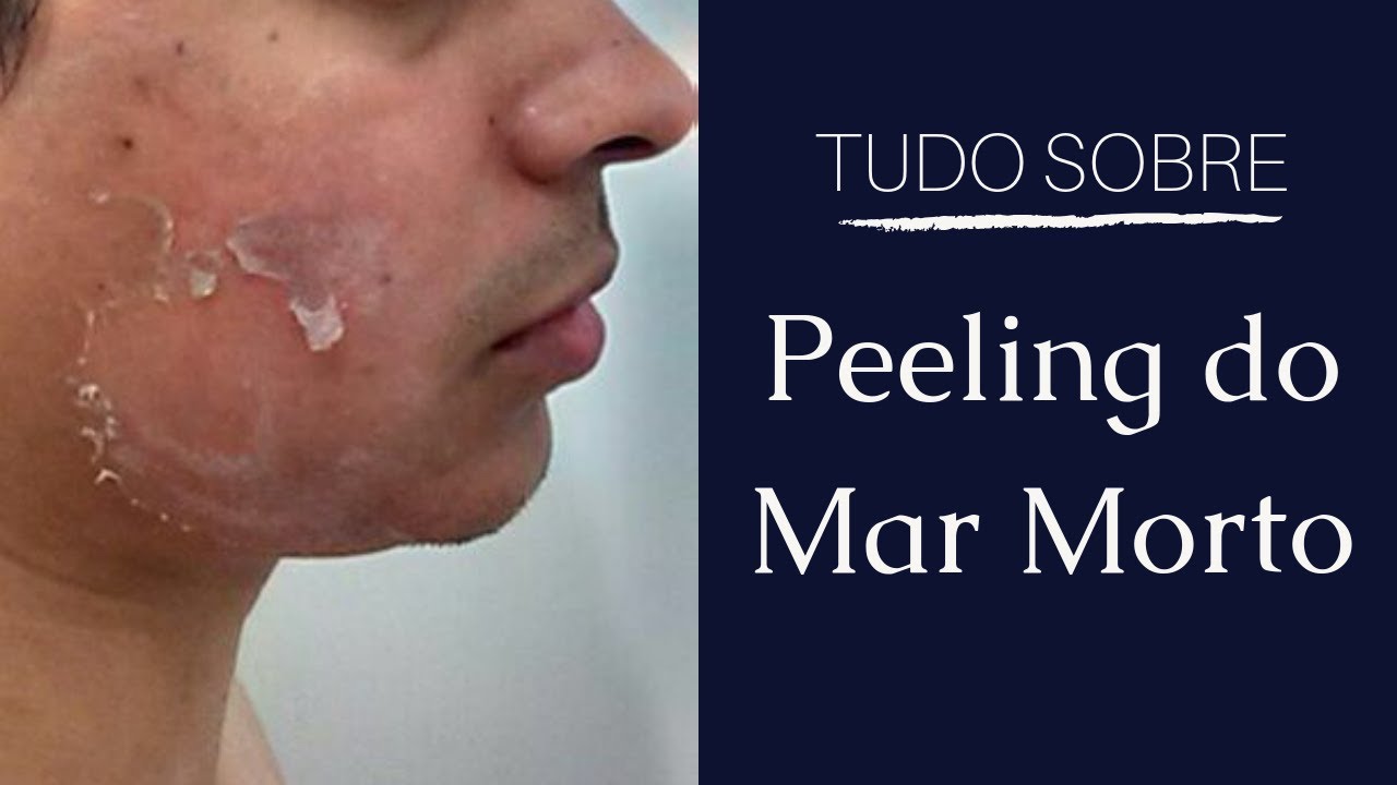 PEELING DO MAR MORTO | ROSE DE MER | DÚVIDAS | ANTES E DEPOIS