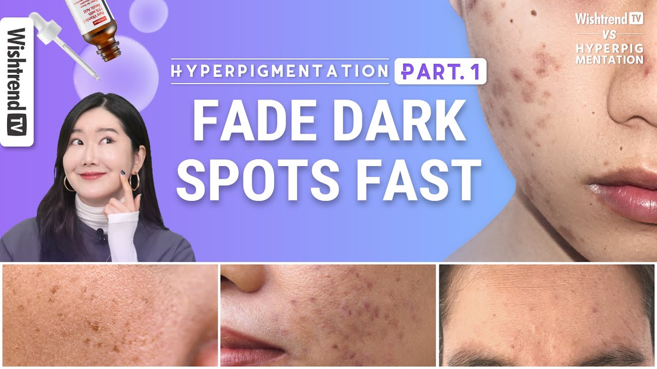 How to Get Rid of Hyperpigmentation, Brightening Skincare Routine | Fade Face Dark Spots Fast part.1