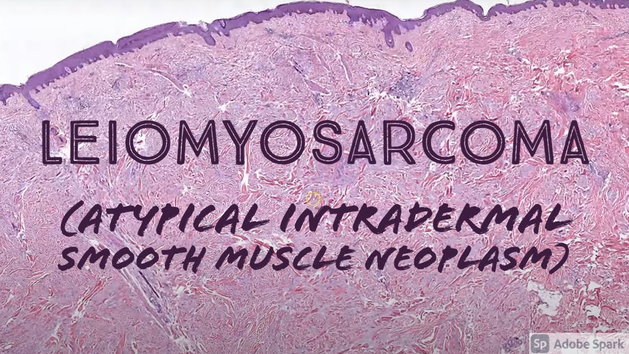 Dermal Leiomyosarcoma (atypical intradermal smooth muscle neoplasm)