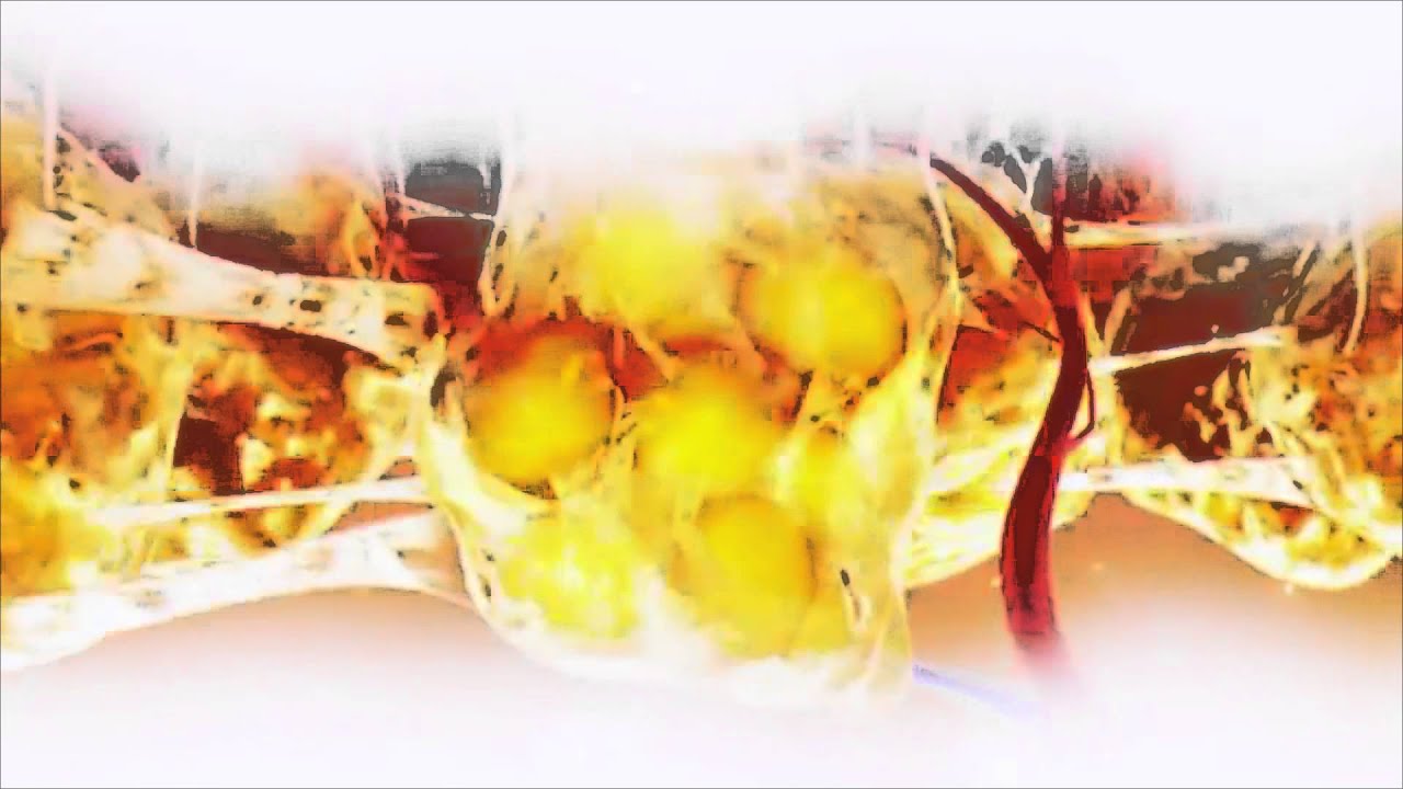 What is the Exilis Elite treatment?