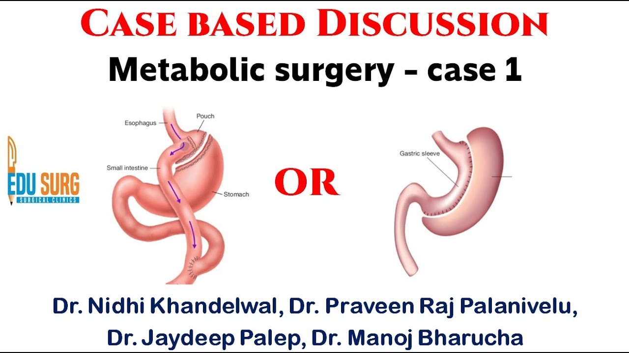 Metabolic syndrome, PCOS & surgery - Case-based discussion 1: Sleeve versus gastric bypass