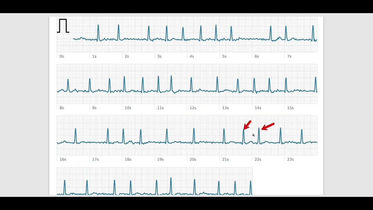 6. Podstawy EKG - migotanie przedsionków na zegarku Apple Watch, Kardia, Samsung.