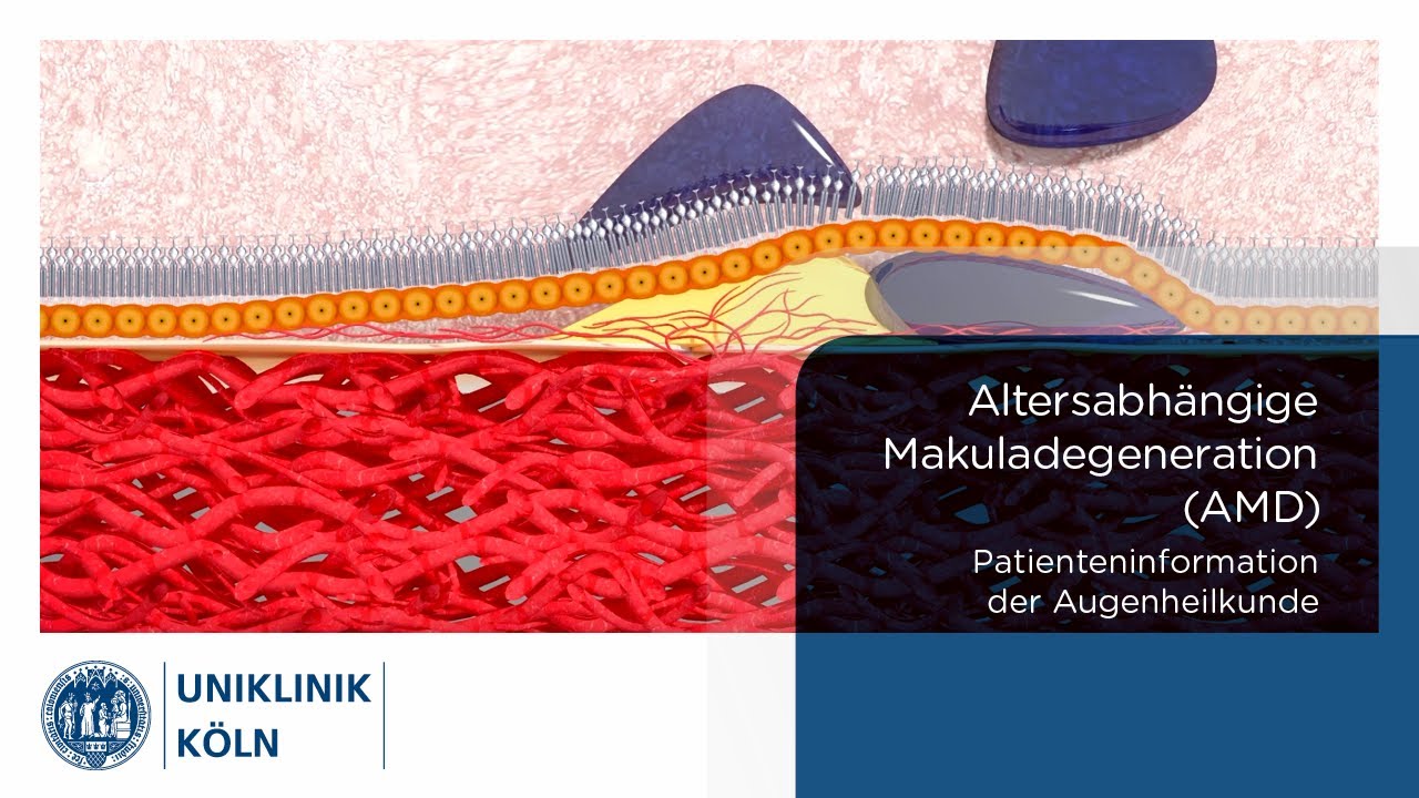 Altersabhängige Makuladegeneration (AMD) | (Patienteninformation Augenklinik) | Uniklinik Köln