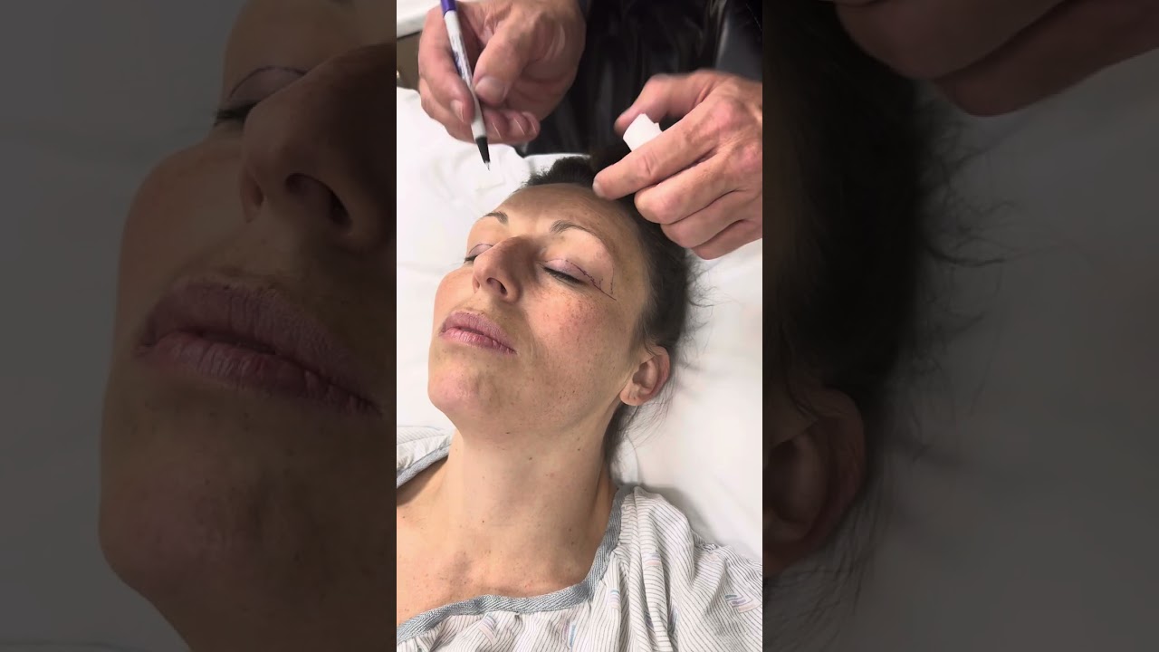 Dr Ward marking upper eyelid incision. Blepharoplasty, Dr Preston Daniel Ward Salt Lake City Utah