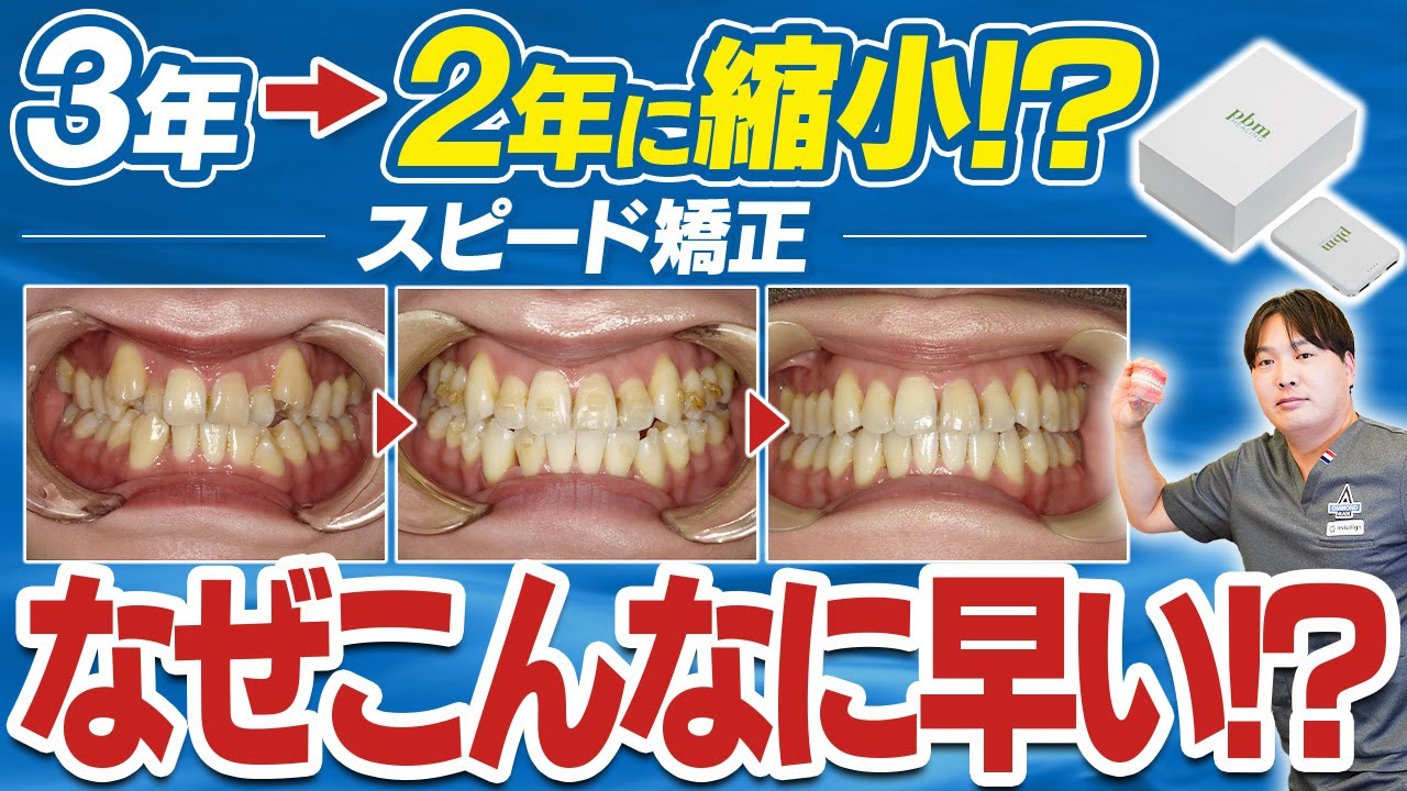 【スピード矯正】光加速矯正装置を使ったマウスピース矯正の期間やどれくらい変化があるかをお見せします。