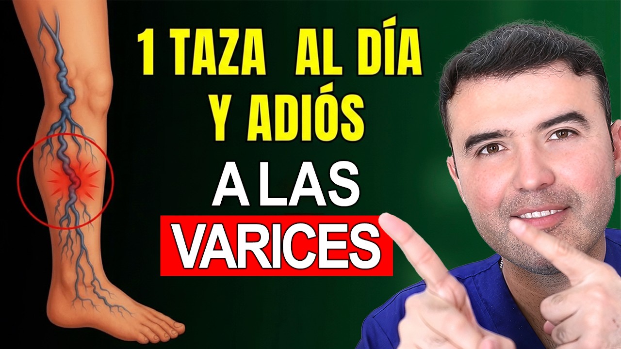 🚨 VÁRICES Eliminadas: 4 Pasos Que Las LIMPIAN 100% Naturalmente Sin Cirugía