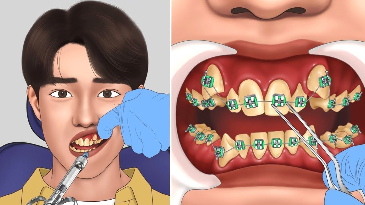 شاهد كيف يتم تركيب تقويم الاسنان في الحقيقة - How Braces are put on