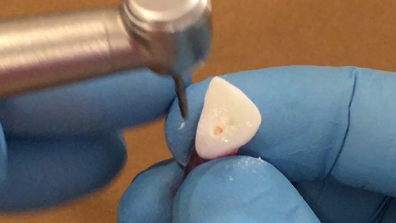 CIRURGIA DE ACESSO- INCISIVO CENTRAL SUPERIOR