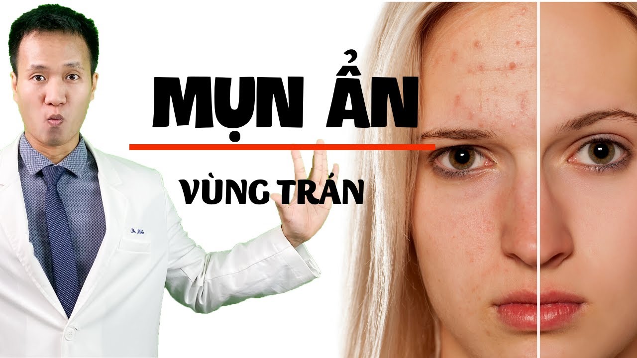 Mụn ẩn ở Trán - Sai lầm nào khiến Skinacare dù nỗ lực cũng KHÔNG cải thiện| Dr Hiếu