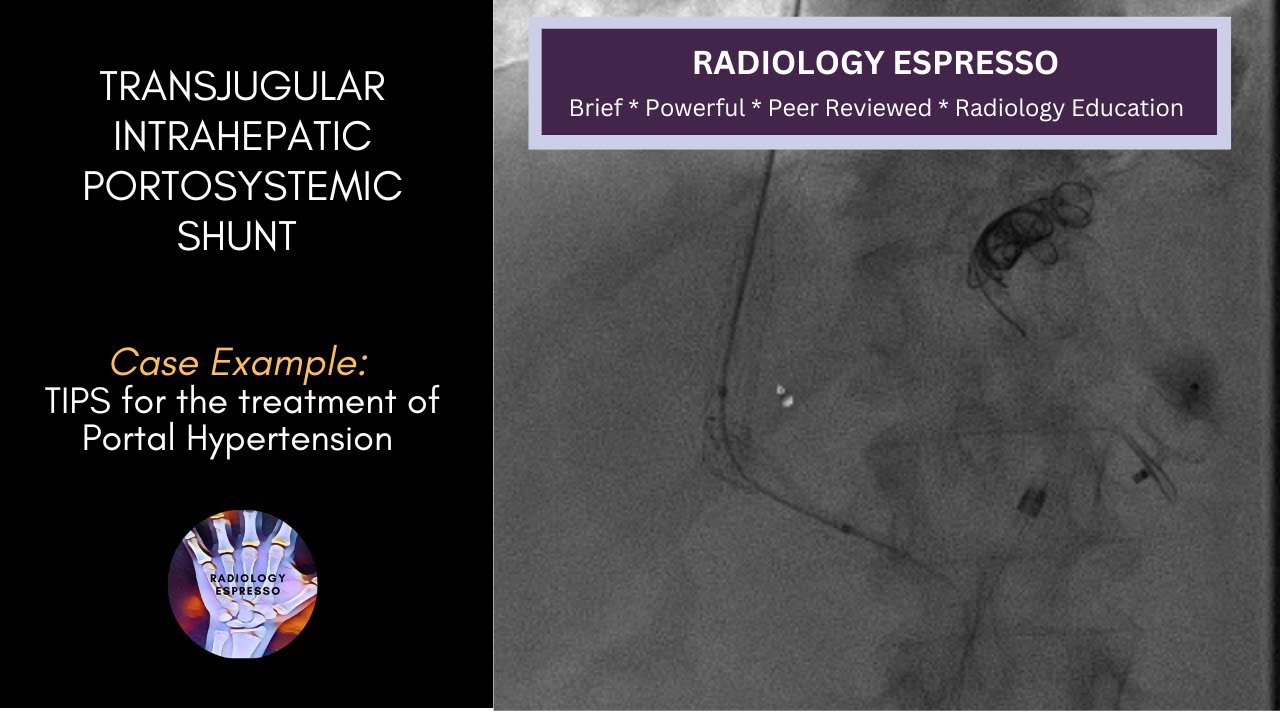 TRANSJUGULAR INTRAHEPATIC PORTOSYSTEMIC SHUNT: Case Example - TIPS, Treatment of Portal Hypertension