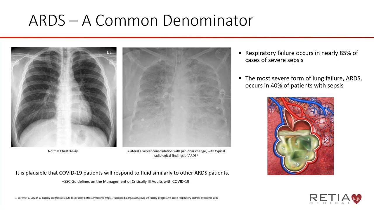 Webinar - Reducing Complications Related to Covid 19 - It's a Fluid Situation