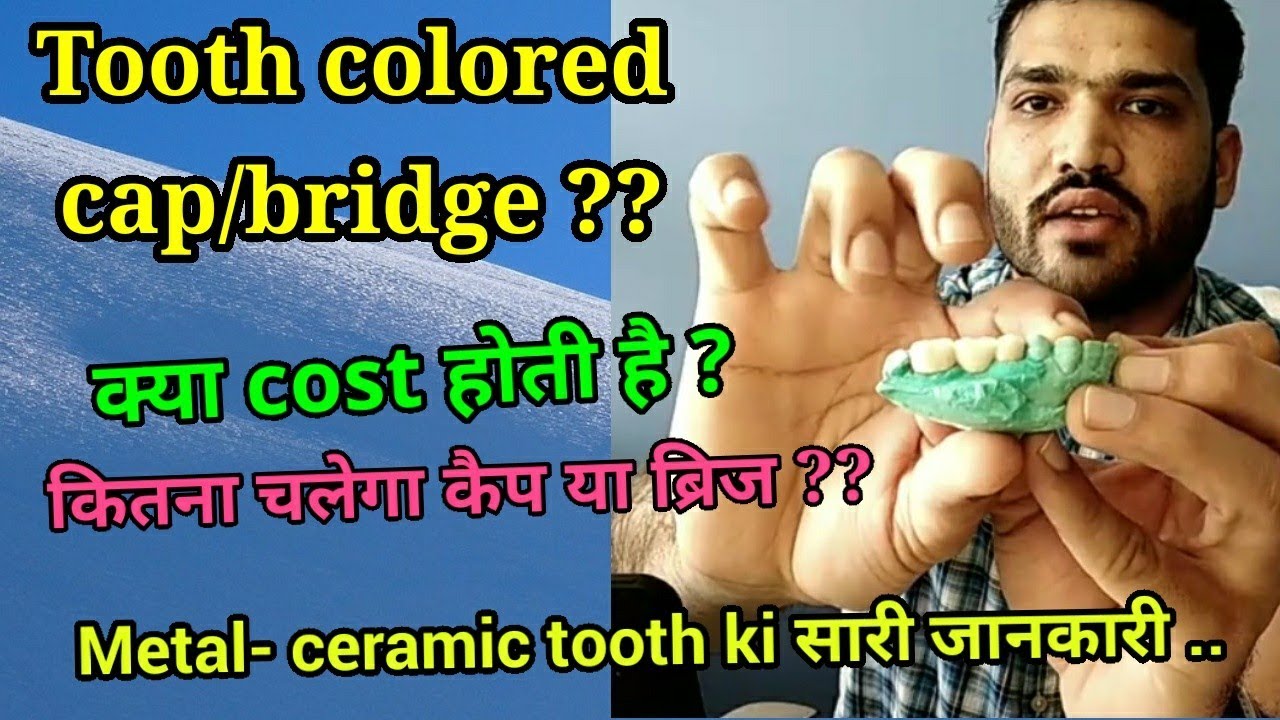 दाँत के कलर का कैप/दाँत लगाने का खर्च?कितना चलता है? Metal ceramic crown/tooth?Cost & durability