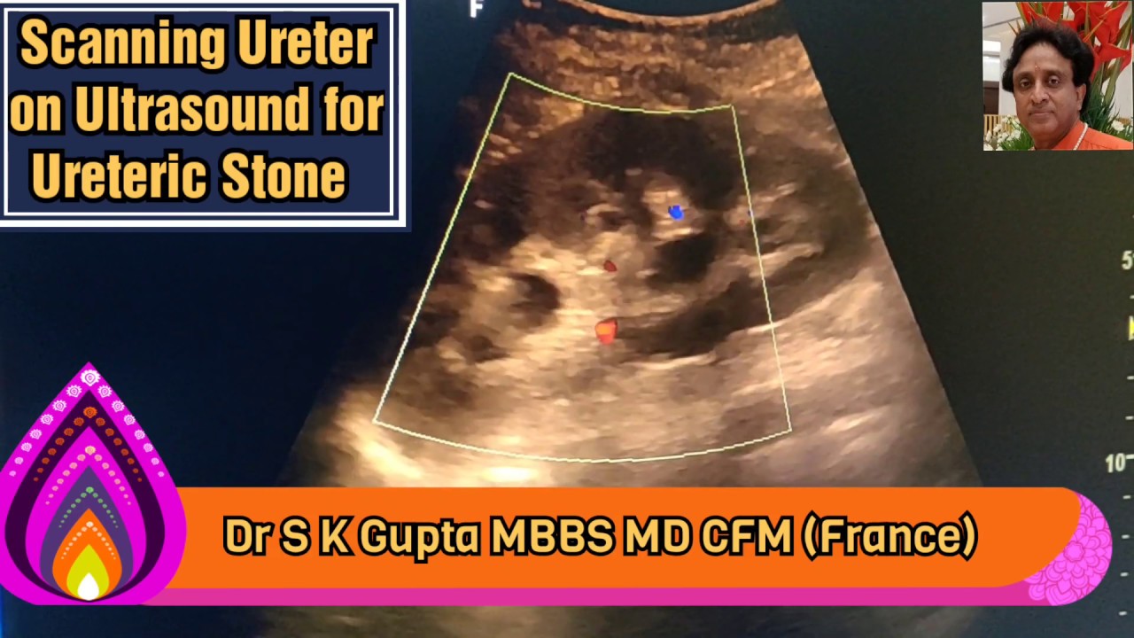 Ureter Ultrasound Kidney stones, how to do? Tricks and Pitfalls