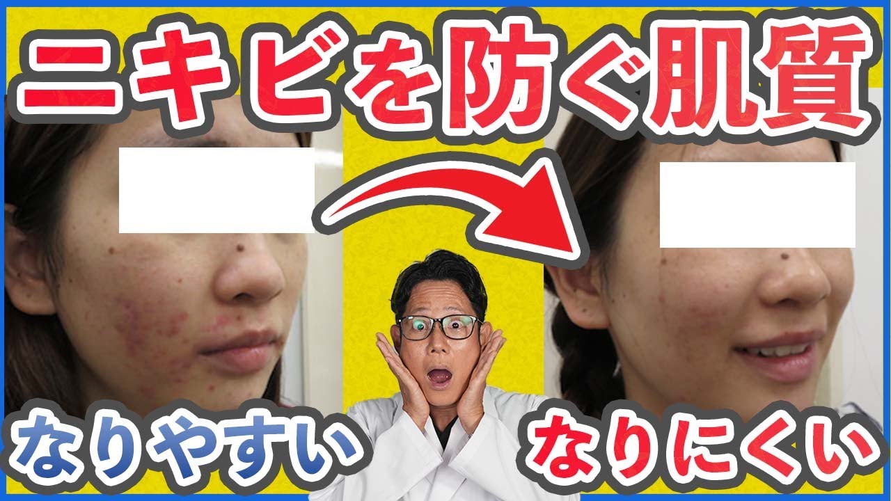 【肌質改善】ニキビになりにくい肌質になるための方法をご紹介します