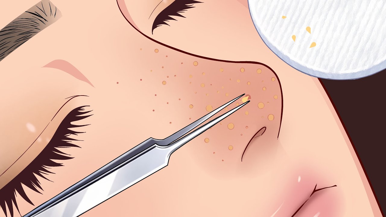Soft ASMR Blackhead Removal✨Deep Pore Care