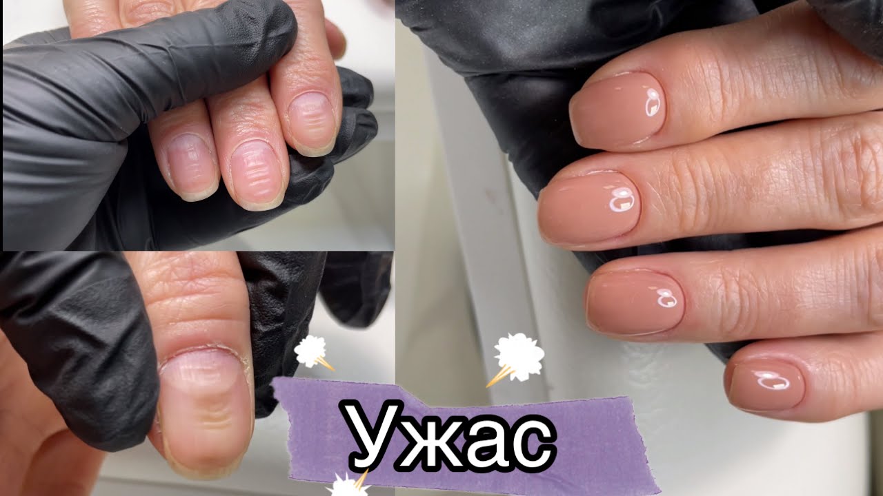 Бугры и ямы на ногтях / Почему образуются изменения ногтевой пластины